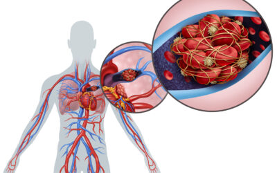embolism pulmonar embolism pulmonar