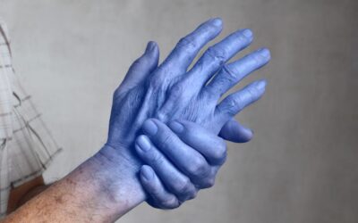 cianoza maini cu cianoza