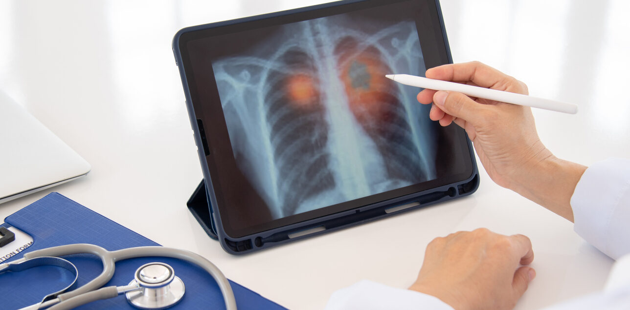 riscul de cancer pulmonar