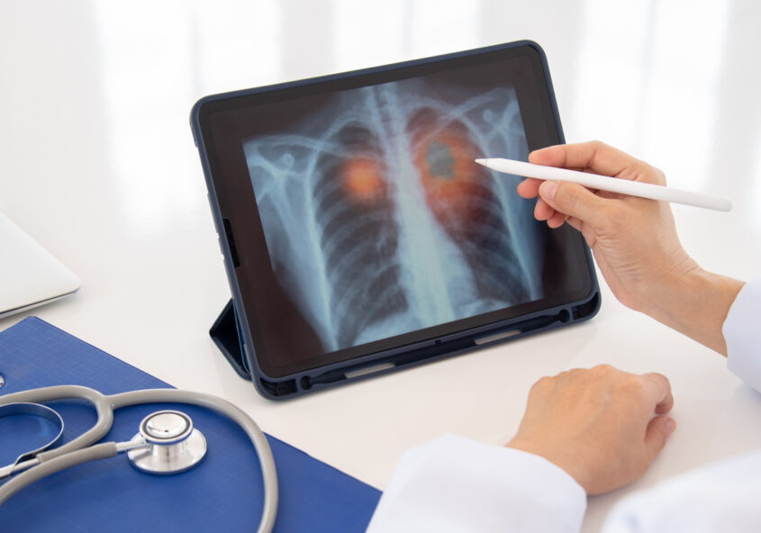 riscul de cancer pulmonar