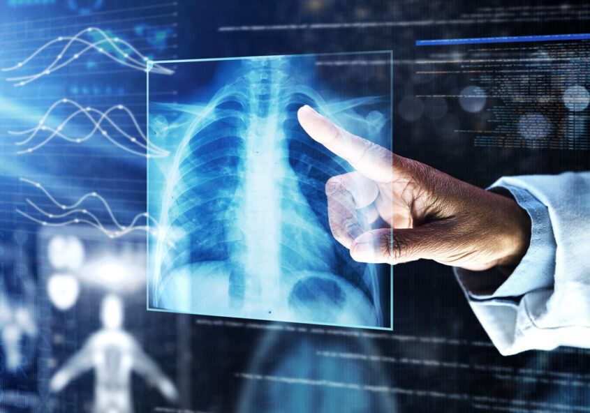 tratamentul cancerului pulmonar