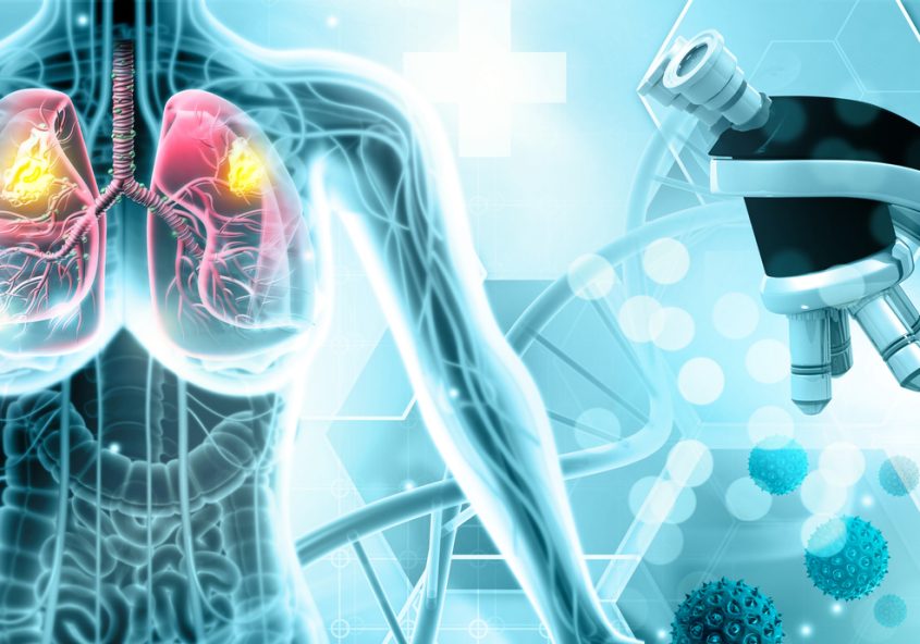 remisia cancerului de plămâni