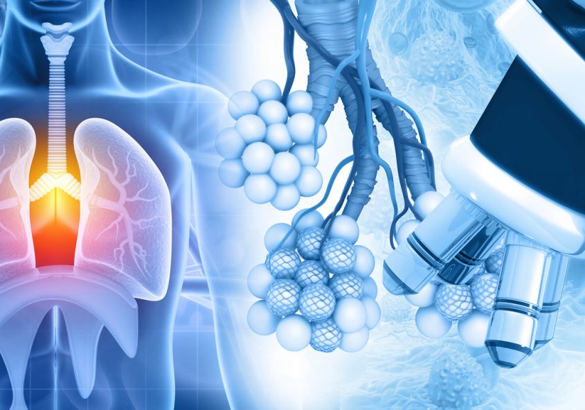 tratament personalizat pentru cancerul pulmonar